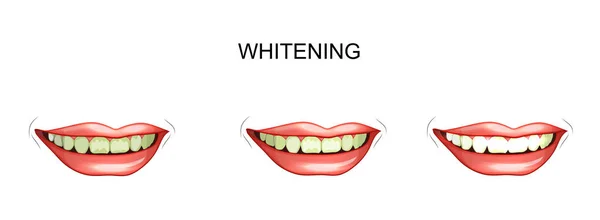 Blanqueamiento de dientes. odontología — Vector de stock