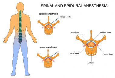 spinal ve Epidural anestezi
