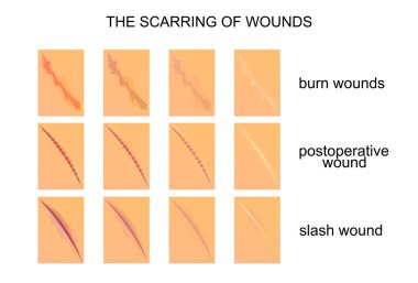 the scarring of wounds clipart