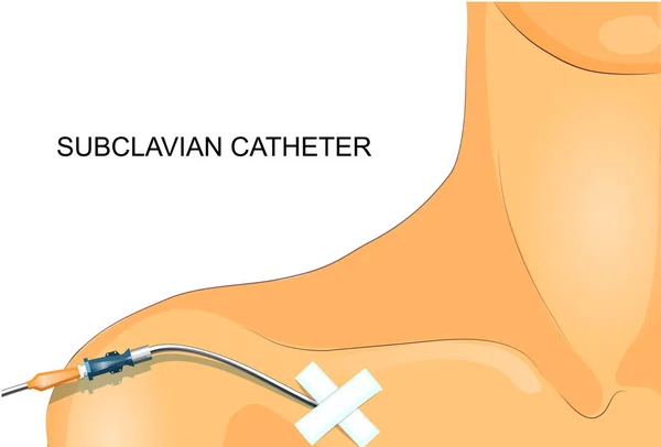 De enscenering van de subclavian katheter — Stockvector