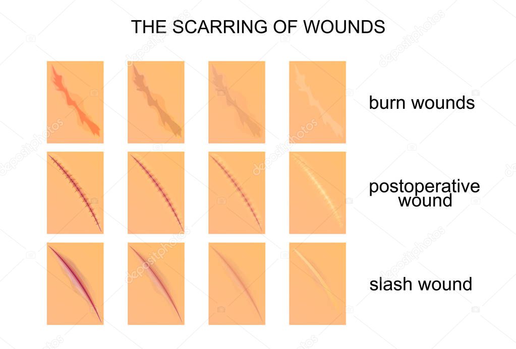 the scarring of wounds