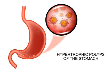hypertrophic polyposis of the stomach clipart