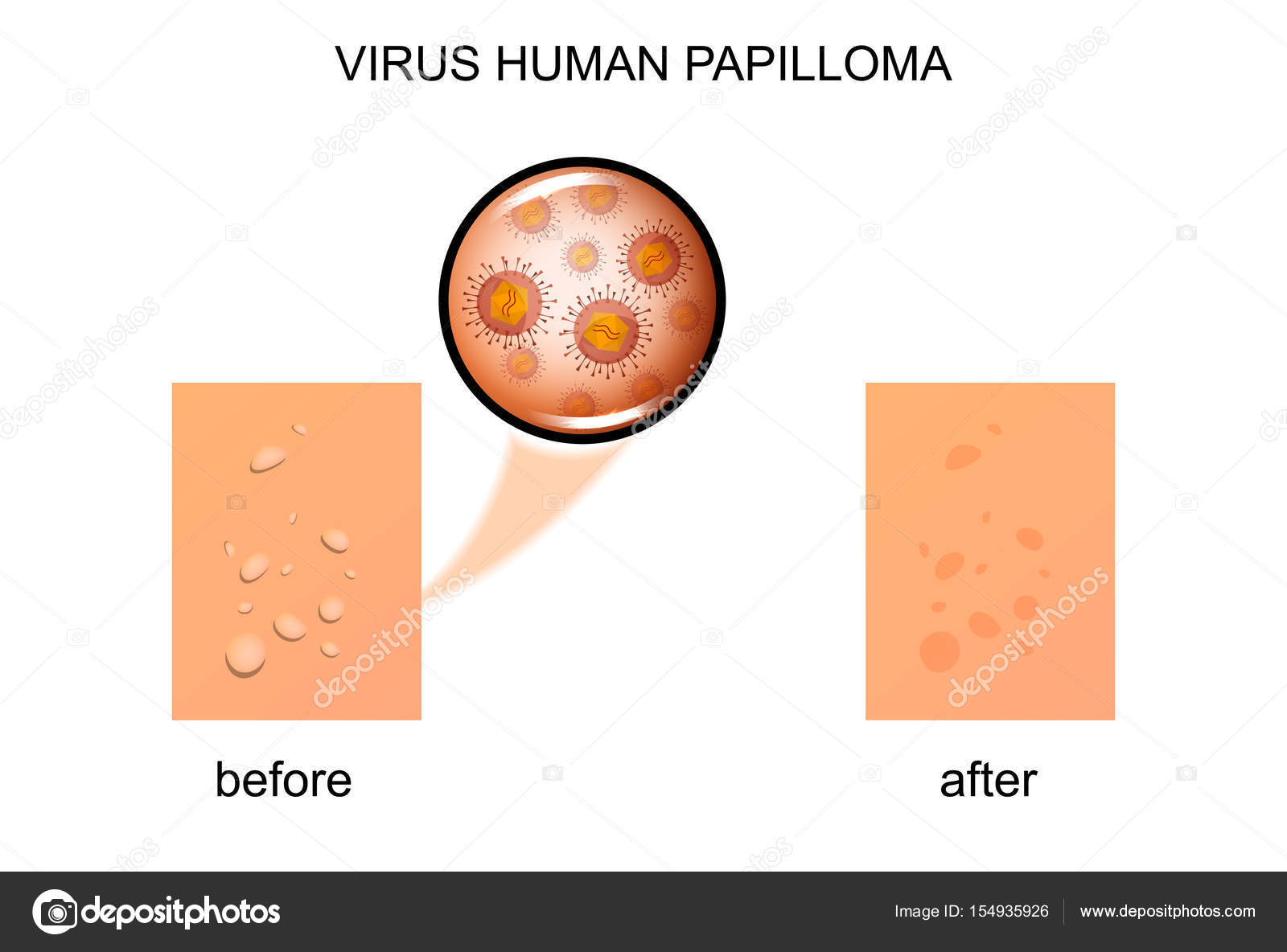 humán papillomavírus po polsku