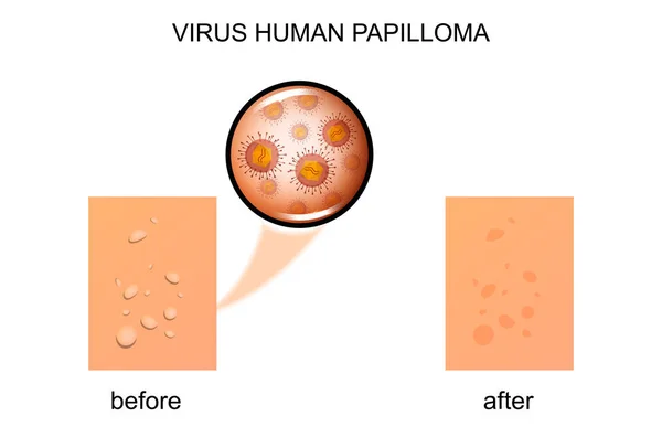 Virus human papilloma — Stock Vector