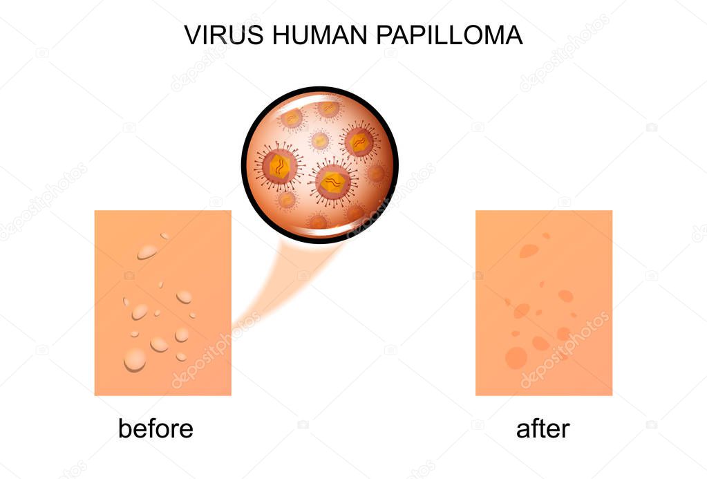 virus human papilloma