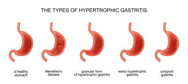 Hipertrofik gastrit türleri