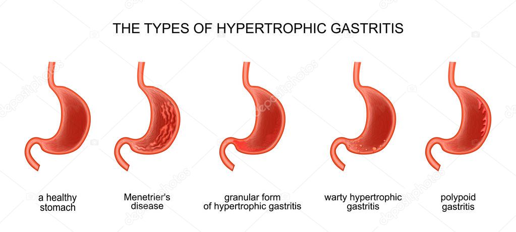 the types of hypertrophic gastritis