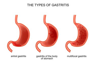 Gastrit türleri