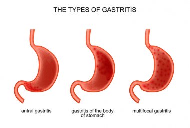 The types of gastritis clipart