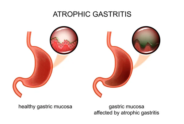 Gastritis atrófica. inflamación — Vector de stock