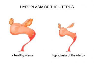 hypoplasia of the uterus clipart