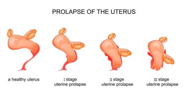 uterin prolapsus aşamaları
