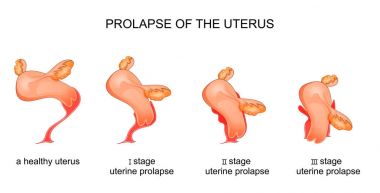 stages of uterine prolapse clipart