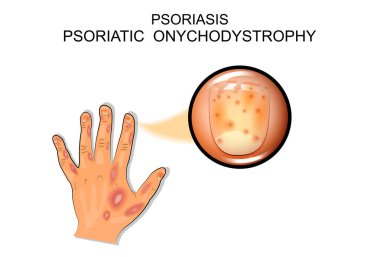sedef hastalığı. Psoriatik onychodystrophy