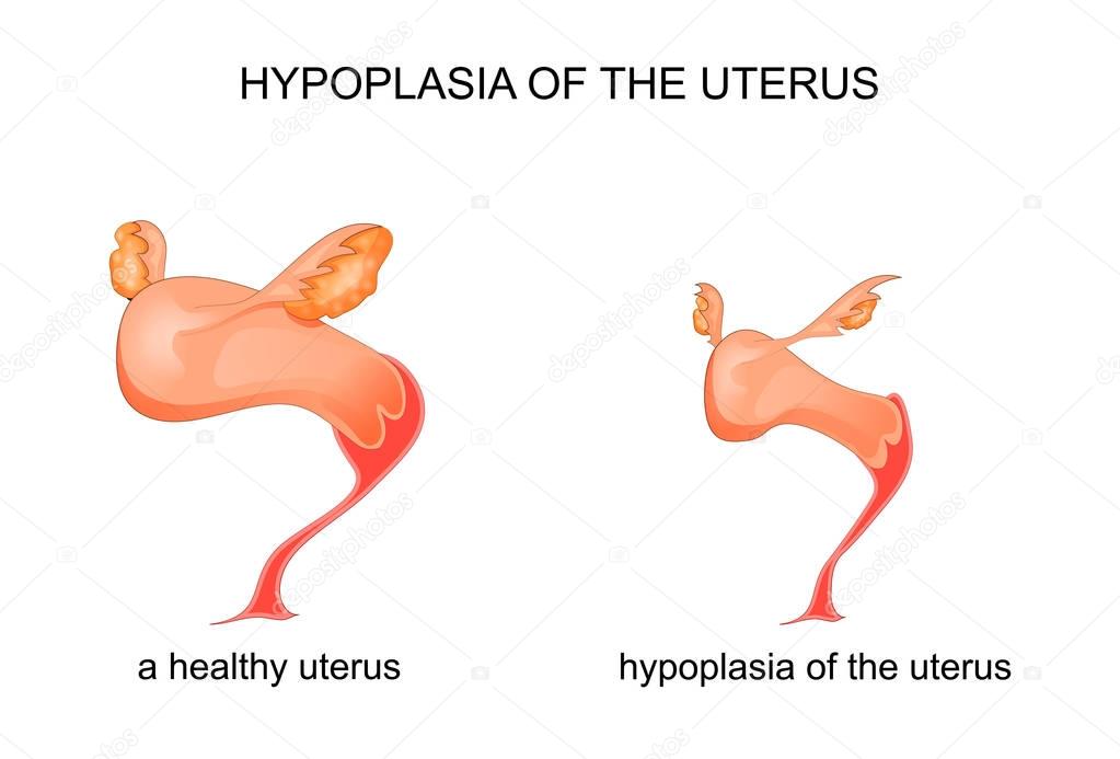 hypoplasia of the uterus
