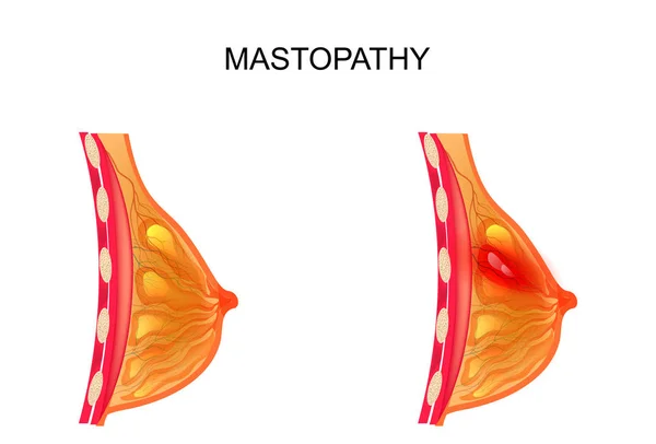 Mastopathie. gesunde und erkrankte Brustdrüse — Stockvektor