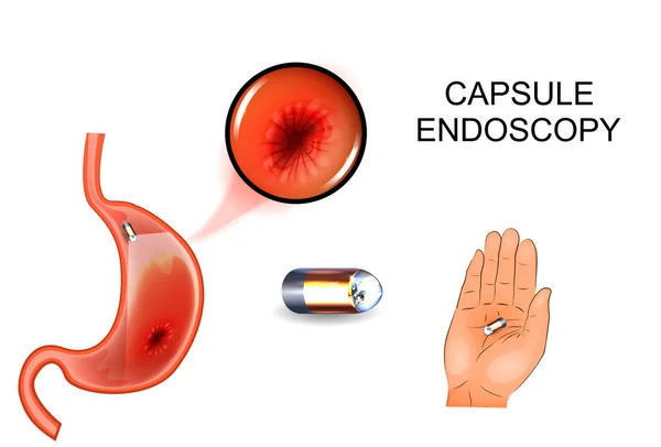 Endoscopia della capsula, EGD, gastroenterologia . — Vettoriale Stock