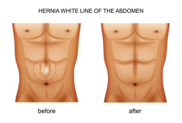 Hernia línea blanca del abdomen — Vector de stock