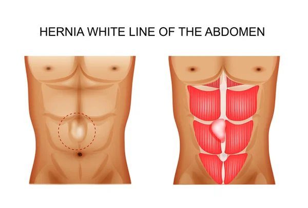 Hernia witte lijn van het abdomen 2 — Stockvector