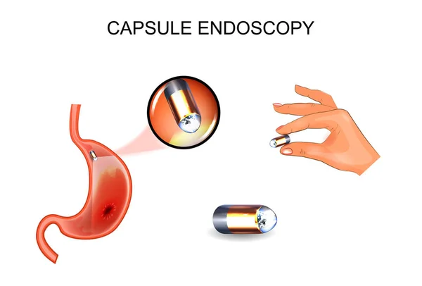 Endoscopia de cápsula. EGD, gastroenterologia . —  Vetores de Stock