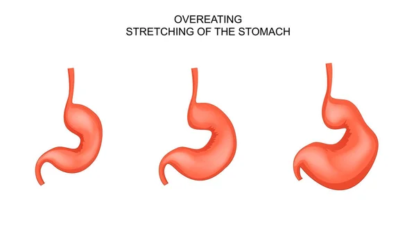 El estómago, distendido de comer en exceso — Vector de stock