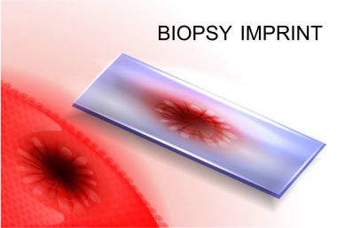 biopsy imprint.diagnosis of cancer clipart