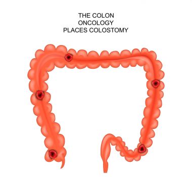 colostomy. place surgical intervention clipart