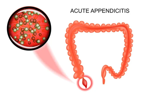 Острый аппендицит. бактерии — стоковый вектор