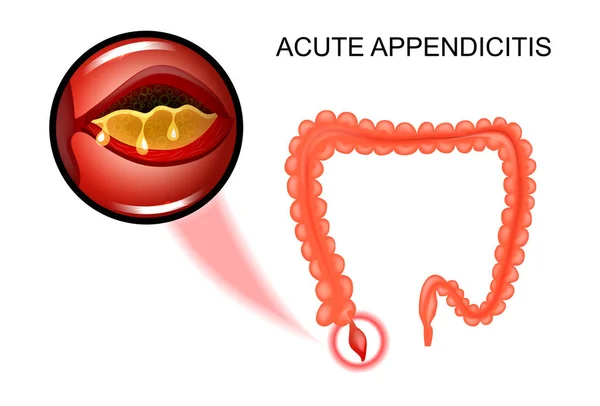L'inflammation de l'appendice — Image vectorielle