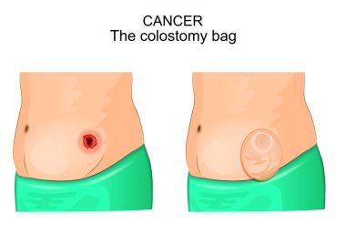 a colostomy bag after operation of colostomy clipart