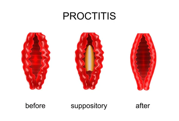 Proktitida. před a po úpravě rektální čípky — Stockový vektor