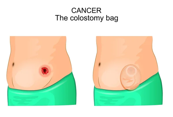 Una bolsa de colostomía después de la operación de colostomía — Archivo Imágenes Vectoriales