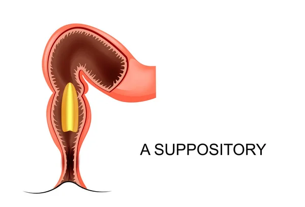 Prolapso das veias hemorroidárias — Vetor de Stock