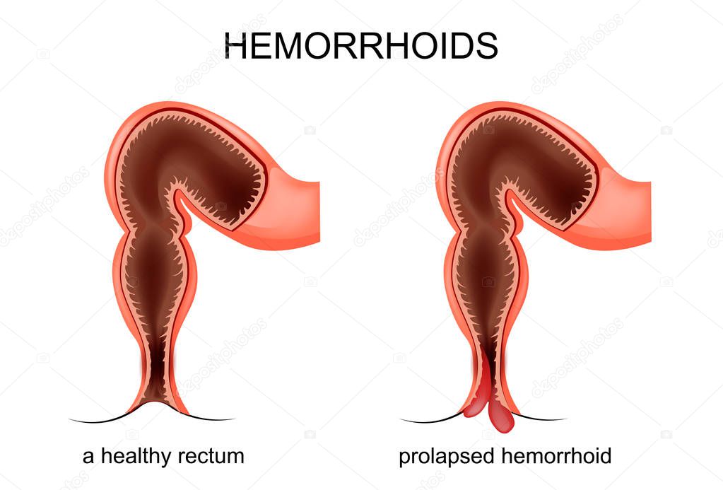 prolapse of the hemorrhoidal veins