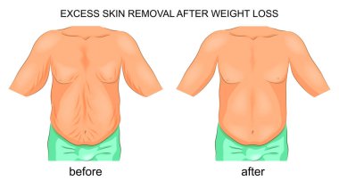 removal of excess skin after weight loss clipart
