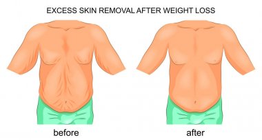 removal of excess skin after weight loss clipart