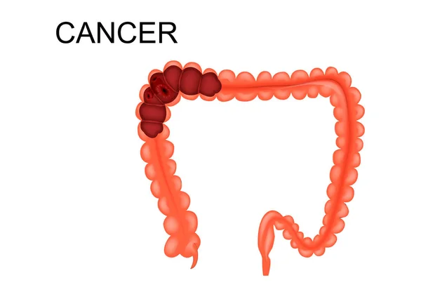Darmkanker is een aanzicht — Stockvector