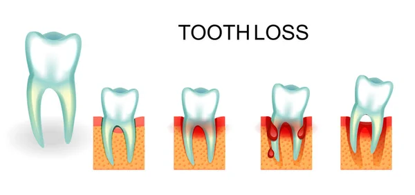 Gesunde und kranke Zähne. Zahnfleischbluten. Zahnverlust — Stockvektor