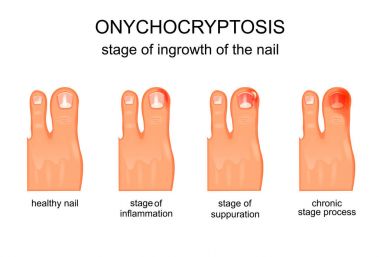 stage of ingrowth of the nail clipart