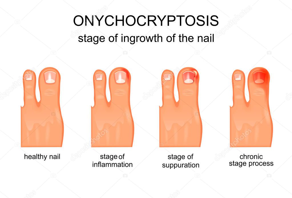 stage of ingrowth of the nail