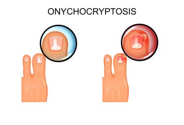 healthy and of ingrowing nail clipart