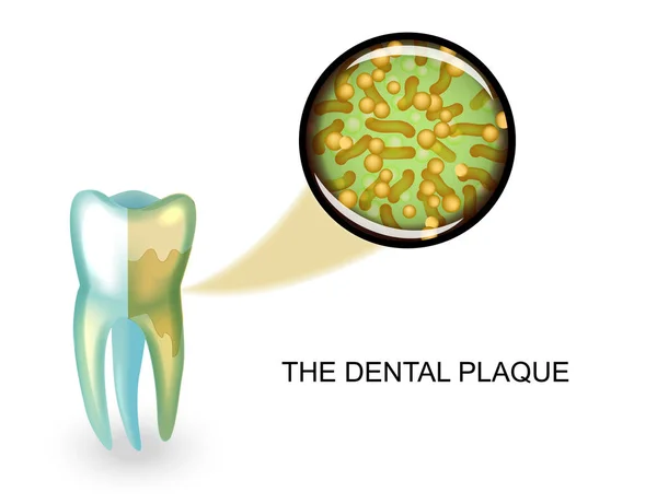 Płytki nazębnej. mikroby w powiększeniu — Wektor stockowy