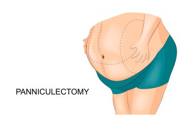 şişman önlük kaldırılması. panniculectomy