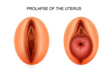 prolapse of the uterus. gynecology clipart