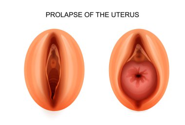 prolapse of the uterus. gynecology clipart