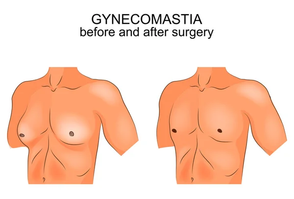 Ginecomastia. antes e depois da cirurgia — Vetor de Stock