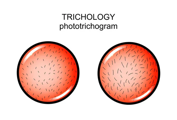 Trichology. phototrichogram. Bőrgyógyászat — Stock Vector