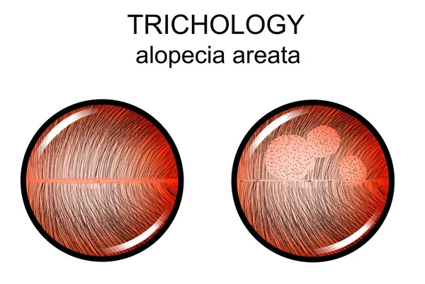 Alopecia areata. trichology — Stock Vector