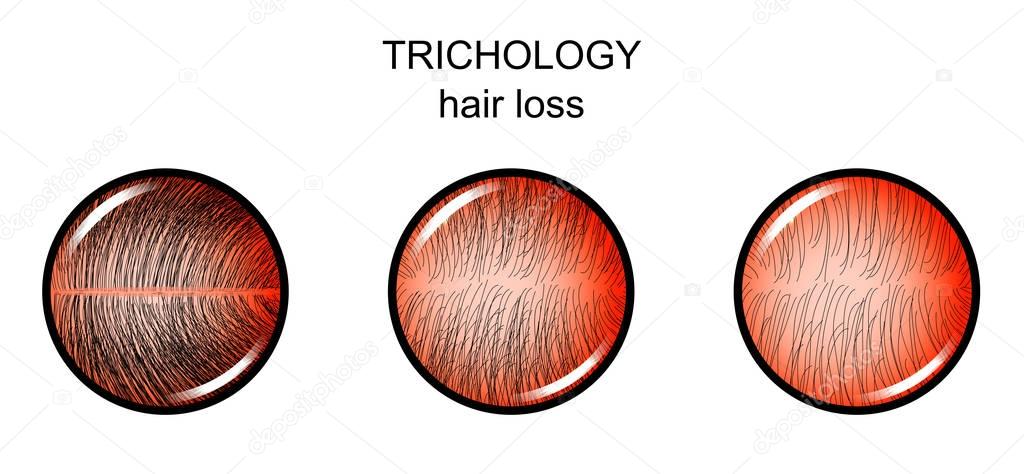 trichology. hair loss