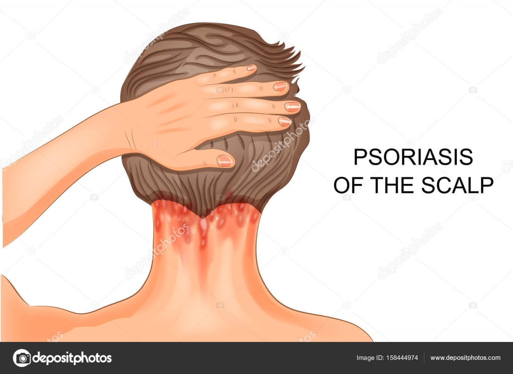 teljes psoriasis kezelsi rend pikkelysömör az arcon hogyan lehet gyorsan meggygyulni